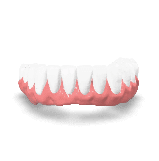 Screw Retained PMMA Bridge