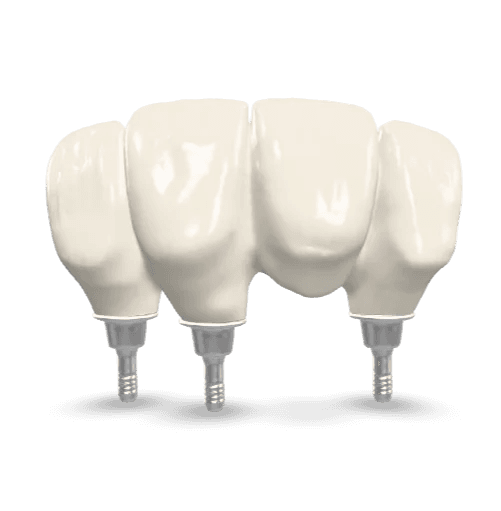 Screw Retained Bridge
