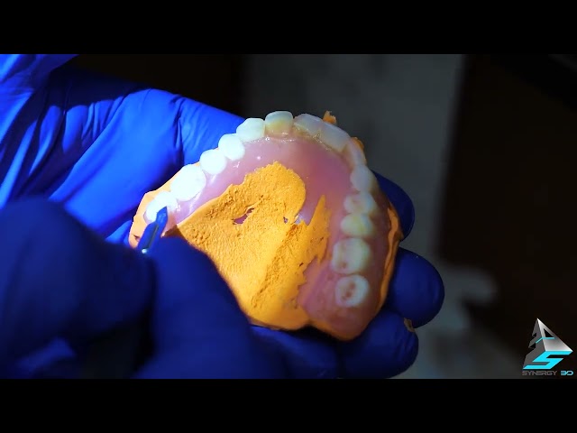 How To Scan With Itero, For Replacement Denture With Final Outcome!